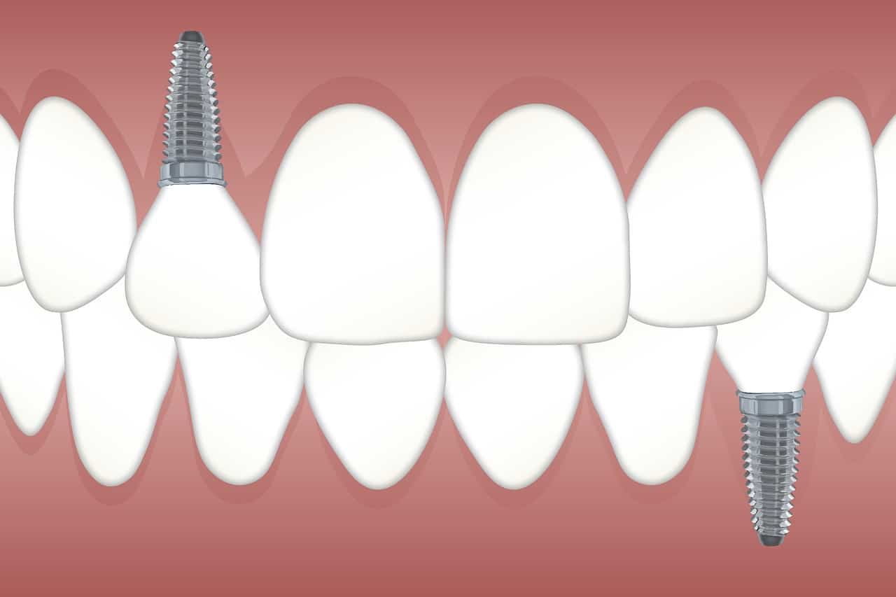 רשלנות רפואית בהשתלת שיניים